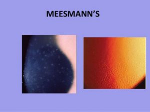 Meesmann epithelial dystrophy
