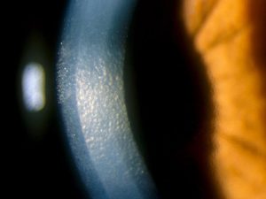 Theil-Behnke corneal dystrophy
